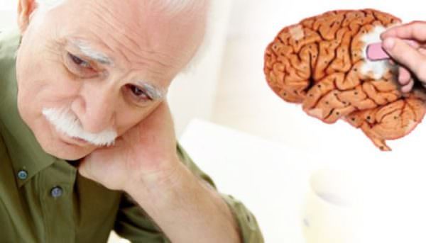 Болезнь альцгеймера последняя стадия: сколько живут, как протекает