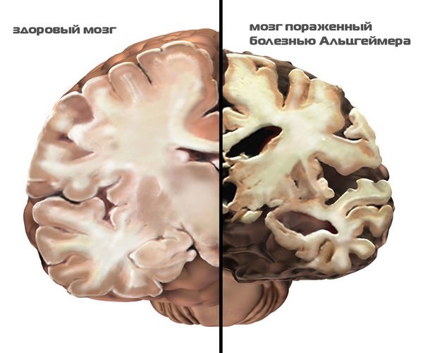 Болезнь альцгеймера симптомы и причины возникновения, лечение синдрома препаратами