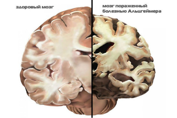 Болезнь альцгеймера симптомы и причины возникновения, лечение синдрома препаратами