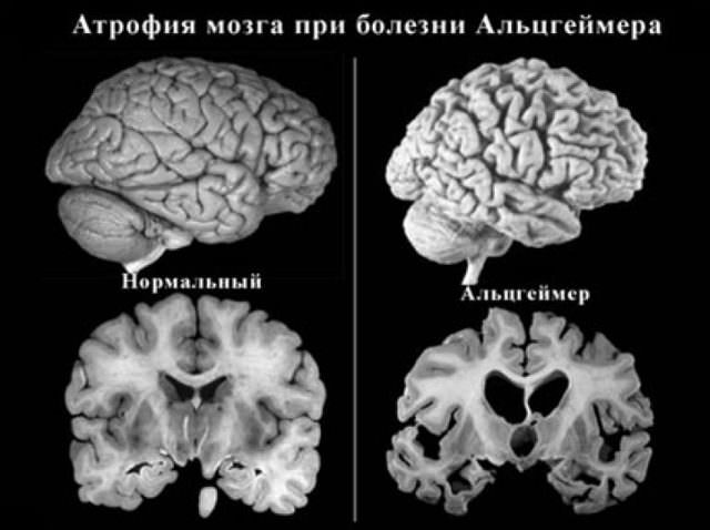 Болезнь альцгеймера симптомы и причины возникновения, лечение синдрома препаратами