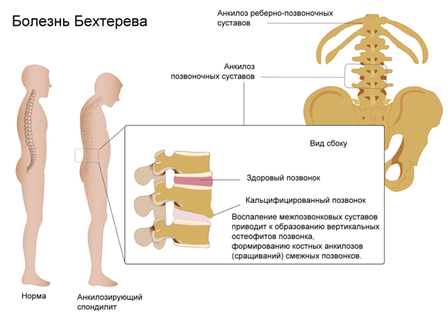 Болезнь бехтерева, или анкилозирующий спондилит – симптомы, причины развития и методы лечения.