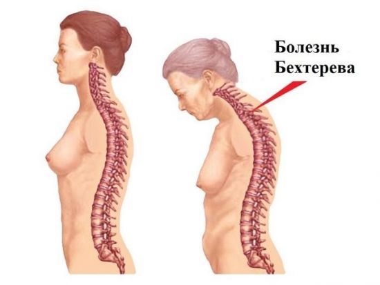 Болезнь бехтерева, или анкилозирующий спондилит – симптомы, причины развития и методы лечения.