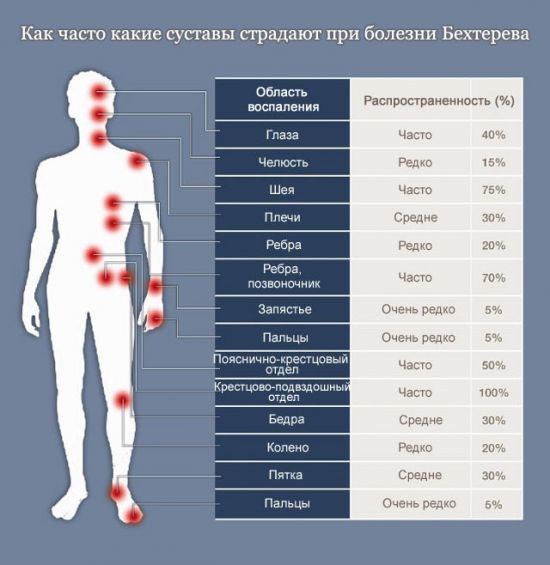 Болезнь бехтерева, или анкилозирующий спондилит – симптомы, причины развития и методы лечения.