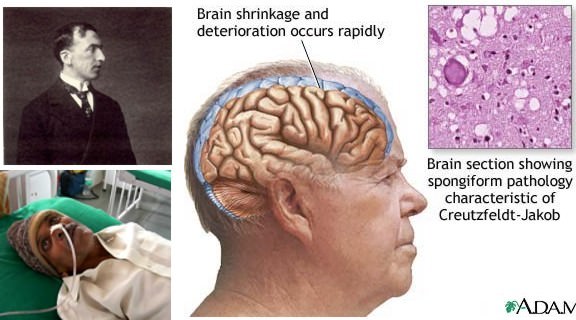 Болезнь крейтцфельдта-якоба или синдром кортико-стриоспинальной дегенерации