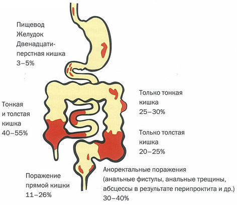 Болезнь крона: симптомы, лечение, диагностика болезни крона толстой кишки и тонкого кишечника.