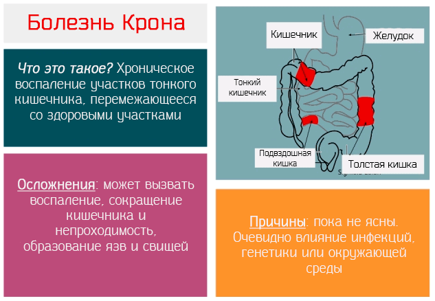 Болезнь крона: симптомы, лечение, диагностика болезни крона толстой кишки и тонкого кишечника.