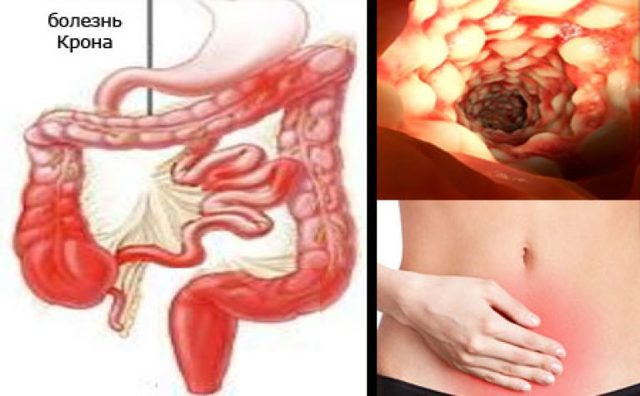 Болезнь крона: симптомы, лечение, диагностика болезни крона толстой кишки и тонкого кишечника.