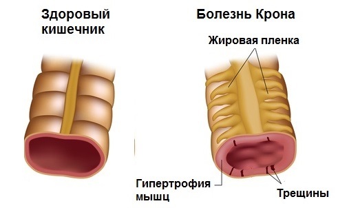 Болезнь крона: симптомы, лечение, диагностика болезни крона толстой кишки и тонкого кишечника.