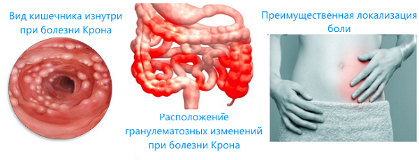 Болезнь крона: симптомы, лечение, диагностика болезни крона толстой кишки и тонкого кишечника.