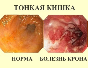 Болезнь крона: симптомы, лечение, диагностика болезни крона толстой кишки и тонкого кишечника.