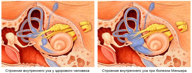 Болезнь меньера симптомы и лечение синдрома