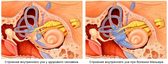 Болезнь меньера симптомы и лечение синдрома