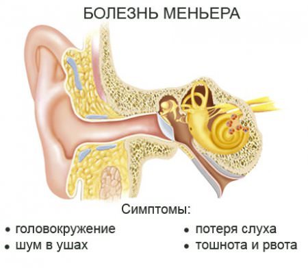 Болезнь меньера симптомы и лечение синдрома