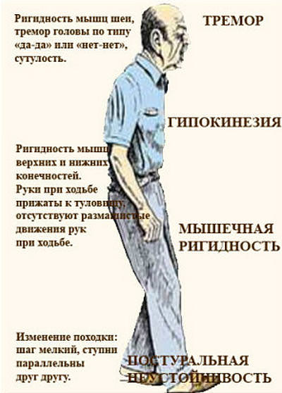 Болезнь паркинсона: причины, симптомы, лечение