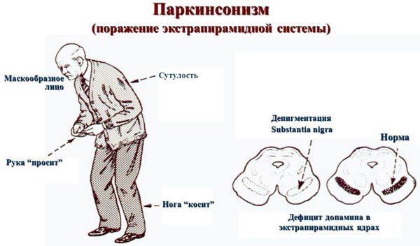 Болезнь паркинсона, симптомы и признаки, лечение синдрома и причины возникновения