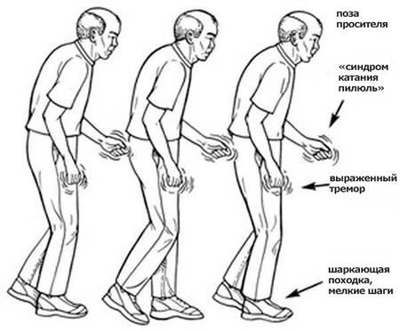 Болезнь паркинсона, симптомы и признаки, лечение синдрома и причины возникновения