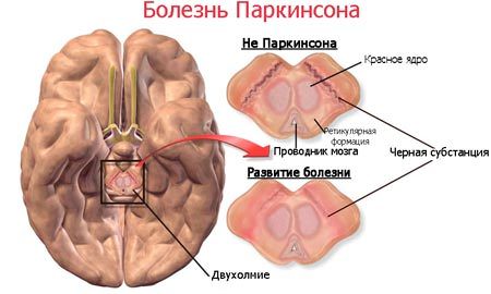 Болезнь паркинсона, симптомы и признаки, лечение синдрома и причины возникновения