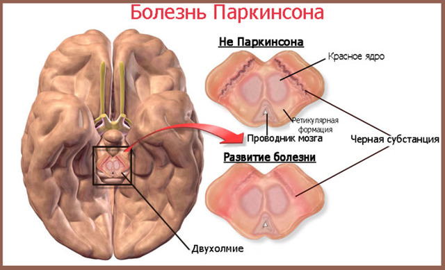 Болезнь паркинсона, симптомы и признаки, лечение синдрома и причины возникновения