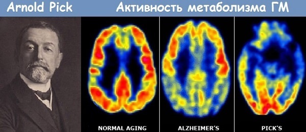 Болезнь пика: причины, симптомы и диагностика, лечение у детей