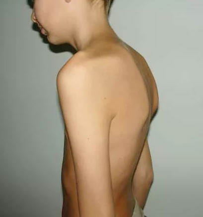 Болезнь шейермана мау — симптомы, лечение, гимнастика