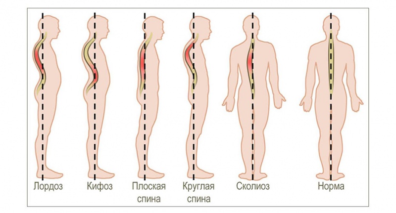 Болезнь шейермана мау — симптомы, лечение, гимнастика