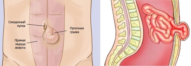 Болезненное уплотнение в животе у женщин:  возможные причины и методы диагностики 