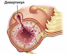 Болезненное уплотнение в животе у женщин:  возможные причины и методы диагностики 