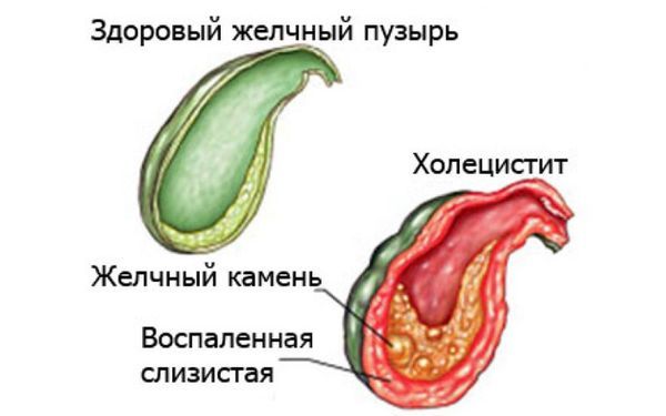 Боли в правом боку как симптом: возможные причины болей в правом подреберье у женщин и мужчин