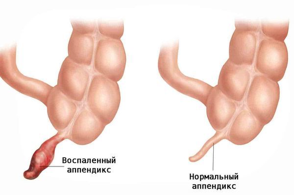 Боли в правом боку как симптом: возможные причины болей в правом подреберье у женщин и мужчин