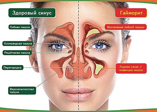 Болит голова из-за гайморита, что делать?