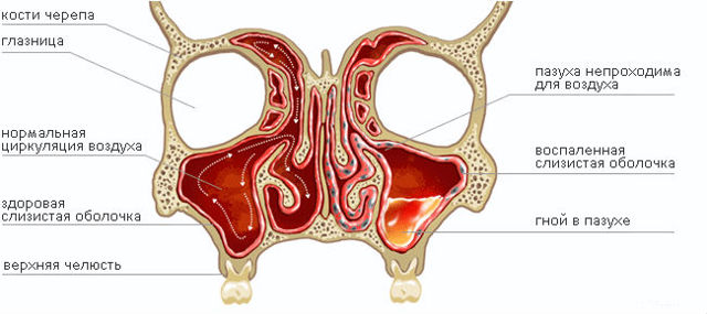 Болит голова из-за гайморита, что делать?