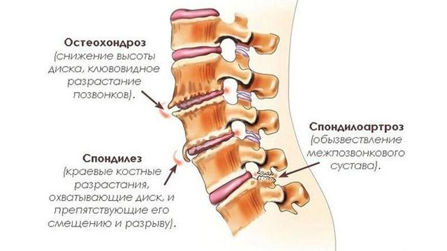 Болит поясница, когда сижу и наклоняюсь, что это может быть?