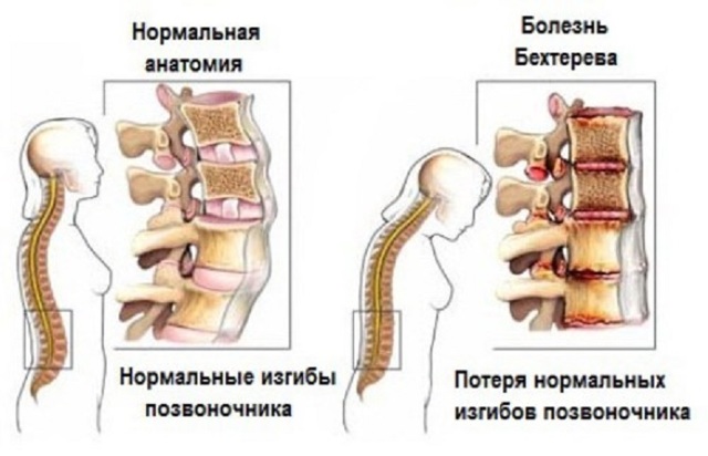 Болит поясница, когда сижу и наклоняюсь, что это может быть?