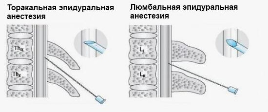 Болит спина после эпидуральной анестезии: что делать?