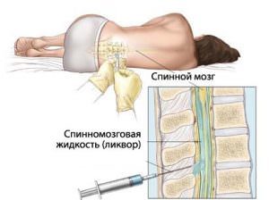 Болит спина после эпидуральной анестезии: что делать?