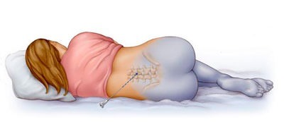 Болит спина после эпидуральной анестезии: что делать?