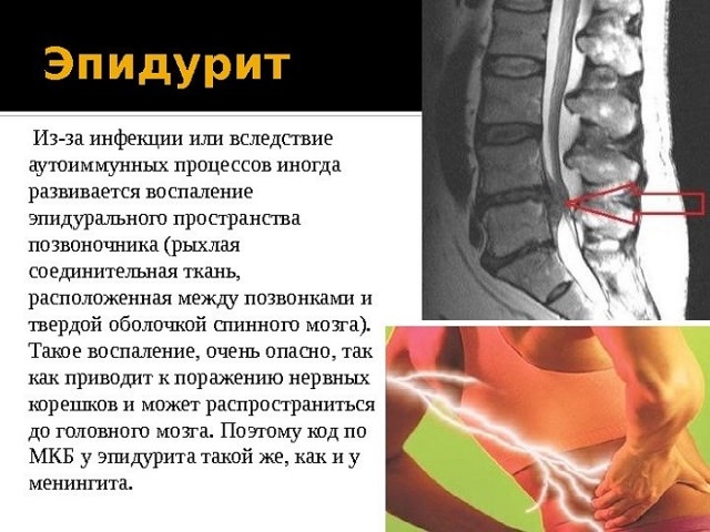 Болит спина после эпидуральной анестезии: что делать?