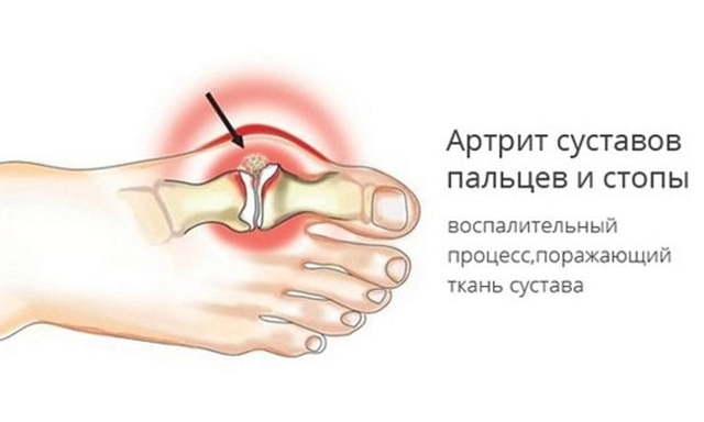 Болит сустав большого пальца на ноге: возможные причины, консервативные и хирургические методы лечения