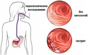 Болит желудок при остром эрозивном гастрите, что делать?