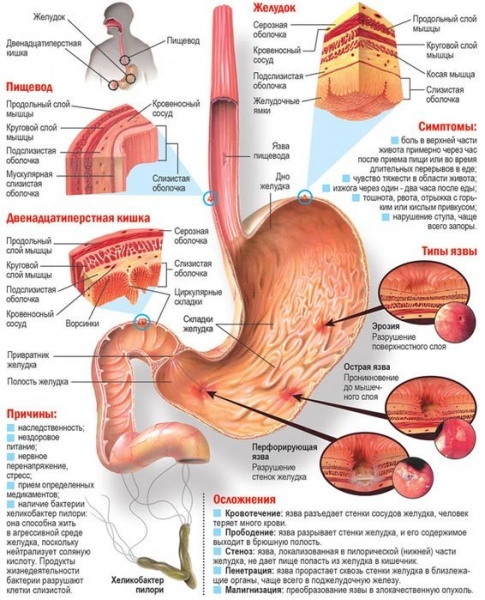 Болит желудок при остром эрозивном гастрите, что делать?