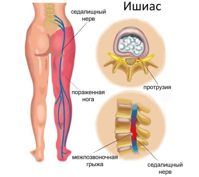 Болят колени: что делать, причины боли в колене при сгибании, при ходьбе