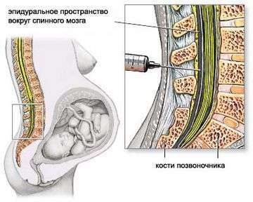 Больно ли делать эпидуральную анестезию при естественных родах?