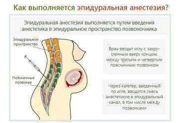 Больно ли делать эпидуральную анестезию при естественных родах?