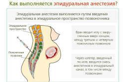 Больно ли делать эпидуральную анестезию при естественных родах?