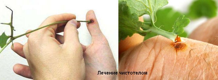 Бородавки — как вылечить бородавки народными средствами / народная медицина