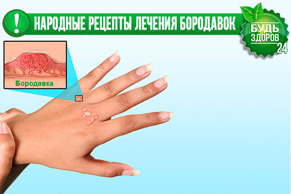 Бородавки — как вылечить бородавки народными средствами / народная медицина