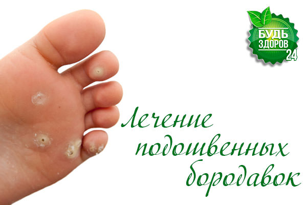 Бородавки — как вылечить бородавки народными средствами / народная медицина