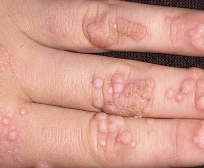 Бородавки — как вылечить бородавки народными средствами / народная медицина