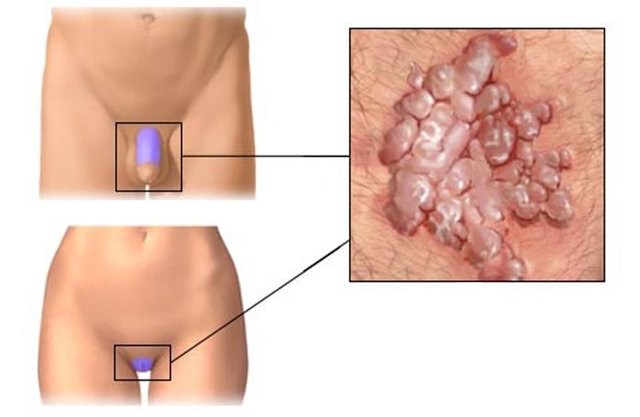 Бородавки в интимных местах: причины и удаление бородавок на половых органах