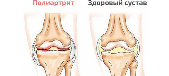 Боррелиоз, симптомы клещевой болезни лайма, последствия у взрослых